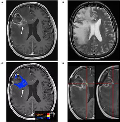 Advanced MRI Protocols to Discriminate Glioma From Treatment Effects: State of the Art and Future Directions
